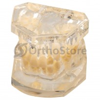 Типодонт без брекетів (нерівні зуби)