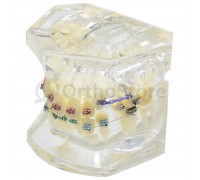 Тіподонт з металевими брекетами та мікроімплантами