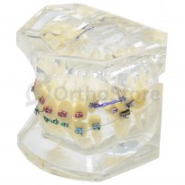 Тіподонт з металевими брекетами та мікроімплантами