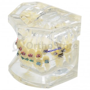 Тіподонт з брекетами + імпланти